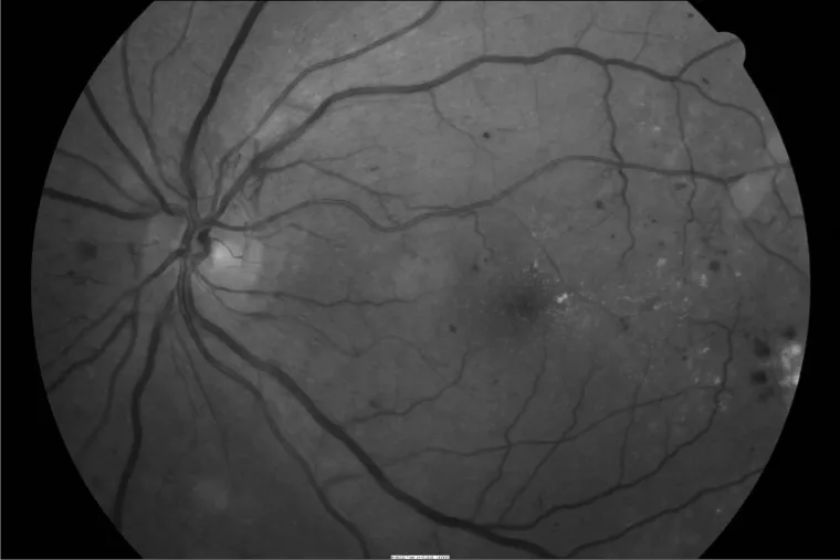 Fundus photograph of proliferative diabetic retinopathy